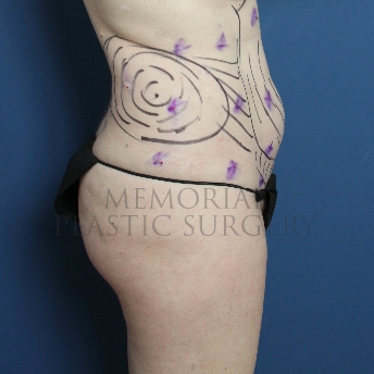 A side view before photo of patient 276 that underwent Liposuction procedures at Memorial Plastic Surgery