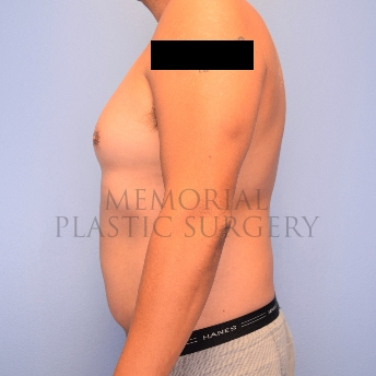 A side view before photo of patient 2221 that underwent Liposuction procedures at Memorial Plastic Surgery