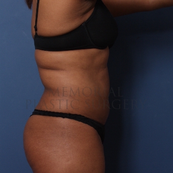 A side view before photo of patient 351 that underwent Liposuction procedures at Memorial Plastic Surgery