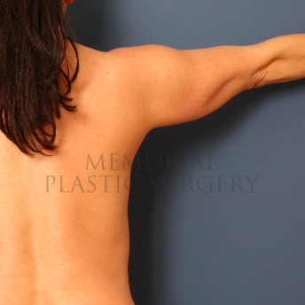 A side view before photo of patient 384 that underwent Liposuction procedures at Memorial Plastic Surgery