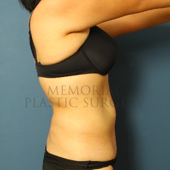 A side view before photo of patient 341 that underwent Liposuction procedures at Memorial Plastic Surgery