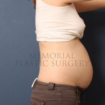 A side view before photo of patient 301 that underwent Liposuction procedures at Memorial Plastic Surgery
