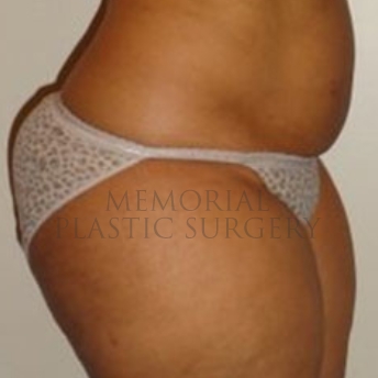 A side view before photo of patient 174 that underwent Liposuction procedures at Memorial Plastic Surgery