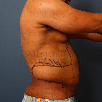 A side view before photo of patient 337 that underwent Liposuction procedures at Memorial Plastic Surgery