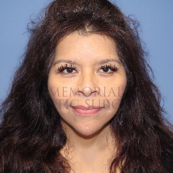 A front view after photo of patient 4127 that underwent Liposuction:NeckLift:Face Lift procedures at Memorial Plastic Surgery