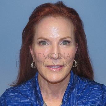 A front view after photo of patient 4121 that underwent Liposuction:NeckLift:Face Lift procedures at Memorial Plastic Surgery