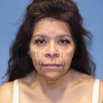 A front view before photo of patient 4127 that underwent Liposuction:NeckLift:Face Lift procedures at Memorial Plastic Surgery
