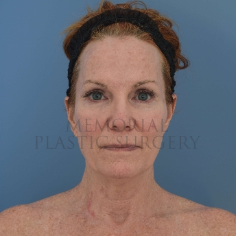 A front view before photo of patient 4121 that underwent Liposuction:NeckLift:Face Lift procedures at Memorial Plastic Surgery