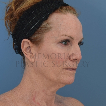 A oblique view before photo of patient 4121 that underwent Liposuction:NeckLift:Face Lift procedures at Memorial Plastic Surgery