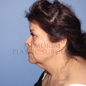 A side view before photo of patient 4127 that underwent Liposuction:NeckLift:Face Lift procedures at Memorial Plastic Surgery