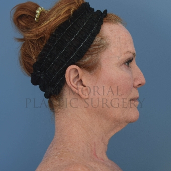 A side view before photo of patient 4121 that underwent Liposuction:NeckLift:Face Lift procedures at Memorial Plastic Surgery