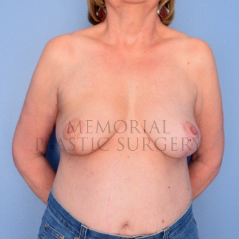 A front view after photo of patient 748 that underwent Lumpectomy Breast Reduction-Lift procedures at Memorial Plastic Surgery