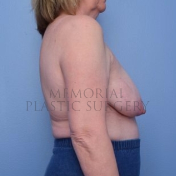 A side view before photo of patient 748 that underwent Lumpectomy Breast Reduction-Lift procedures at Memorial Plastic Surgery