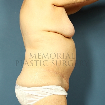 A side view after photo of patient 222 that underwent Mastopexy:Abdominoplasty Tummy Tuck procedures at Memorial Plastic Surgery