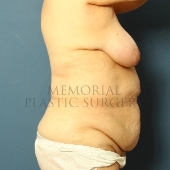 A side view before photo of patient 222 that underwent Mastopexy:Abdominoplasty Tummy Tuck procedures at Memorial Plastic Surgery