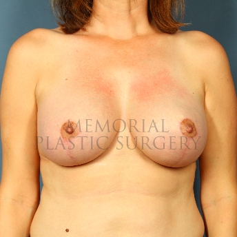 A front view after photo of patient 421 that underwent Mastopexy procedures at Memorial Plastic Surgery