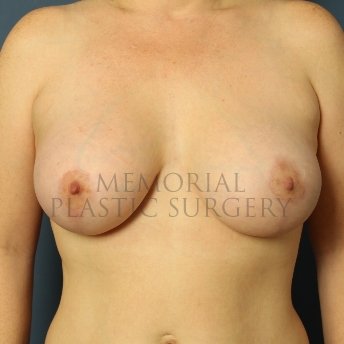 A front view after photo of patient 429 that underwent Mastopexy procedures at Memorial Plastic Surgery