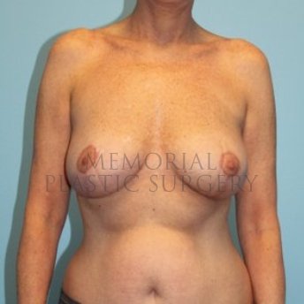 A front view after photo of patient 199 that underwent Mastopexy procedures at Memorial Plastic Surgery