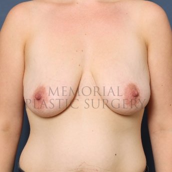 A front view before photo of patient 416 that underwent Mastopexy procedures at Memorial Plastic Surgery