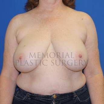 A front view before photo of patient 1848 that underwent Mastopexy procedures at Memorial Plastic Surgery