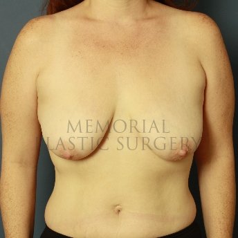 A front view before photo of patient 429 that underwent Mastopexy procedures at Memorial Plastic Surgery