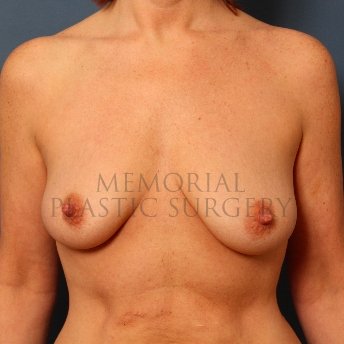 A front view before photo of patient 412 that underwent Mastopexy procedures at Memorial Plastic Surgery
