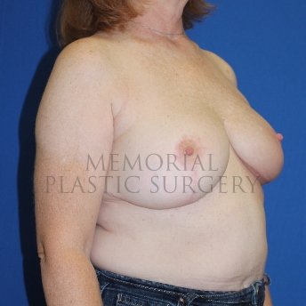 A oblique view after photo of patient 1848 that underwent Mastopexy procedures at Memorial Plastic Surgery