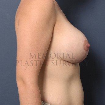 A side view after photo of patient 416 that underwent Mastopexy procedures at Memorial Plastic Surgery