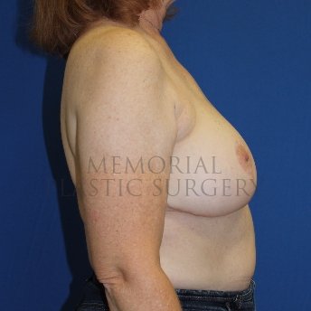 A side view after photo of patient 1848 that underwent Mastopexy procedures at Memorial Plastic Surgery