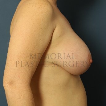 A side view after photo of patient 429 that underwent Mastopexy procedures at Memorial Plastic Surgery