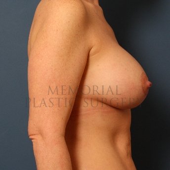 A side view after photo of patient 412 that underwent Mastopexy procedures at Memorial Plastic Surgery