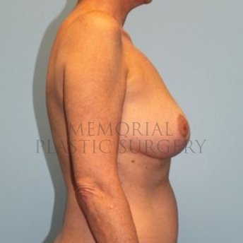 A side view after photo of patient 199 that underwent Mastopexy procedures at Memorial Plastic Surgery