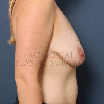 A side view before photo of patient 416 that underwent Mastopexy procedures at Memorial Plastic Surgery
