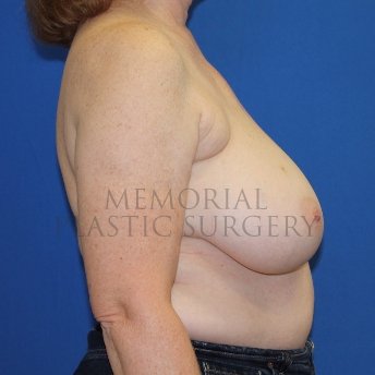 A side view before photo of patient 1848 that underwent Mastopexy procedures at Memorial Plastic Surgery