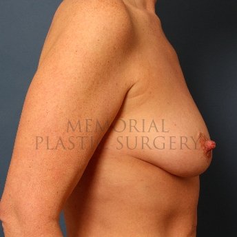 A side view before photo of patient 412 that underwent Mastopexy procedures at Memorial Plastic Surgery