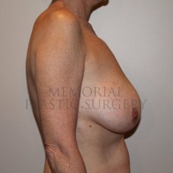 A side view before photo of patient 199 that underwent Mastopexy procedures at Memorial Plastic Surgery
