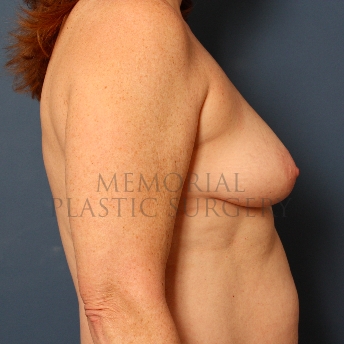 A side view before photo of patient 414 that underwent Mastopexy procedures at Memorial Plastic Surgery