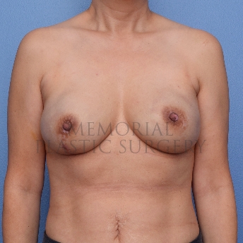 A front view after photo of patient 298 that underwent Nipple Sparing Mastectomy procedures at Memorial Plastic Surgery