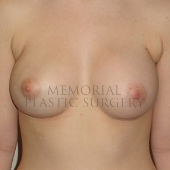 A front view after photo of patient 188 that underwent Nipple Sparing Mastectomy procedures at Memorial Plastic Surgery