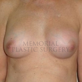 A front view after photo of patient 173 that underwent Nipple Sparing Mastectomy procedures at Memorial Plastic Surgery