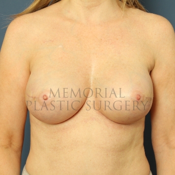 A front view after photo of patient 249 that underwent Nipple Sparing Mastectomy procedures at Memorial Plastic Surgery