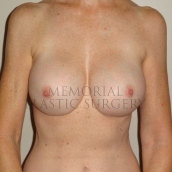 A front view after photo of patient 205 that underwent Nipple Sparing Mastectomy procedures at Memorial Plastic Surgery