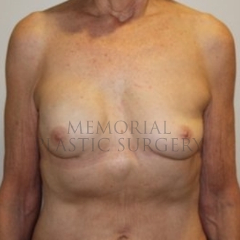 A front view after photo of patient 194 that underwent Nipple Sparing Mastectomy procedures at Memorial Plastic Surgery