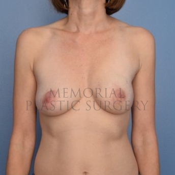 A front view after photo of patient 296 that underwent Nipple Sparing Mastectomy procedures at Memorial Plastic Surgery