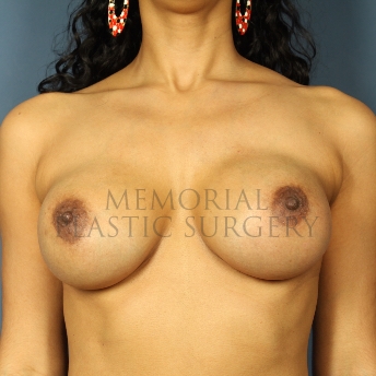 A front view after photo of patient 259 that underwent Nipple Sparing Mastectomy procedures at Memorial Plastic Surgery