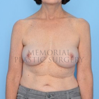 A front view before photo of patient 297 that underwent Nipple Sparing Mastectomy procedures at Memorial Plastic Surgery