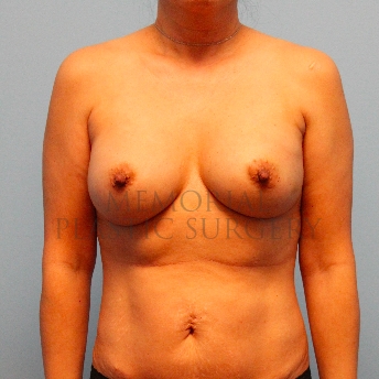 A front view before photo of patient 298 that underwent Nipple Sparing Mastectomy procedures at Memorial Plastic Surgery