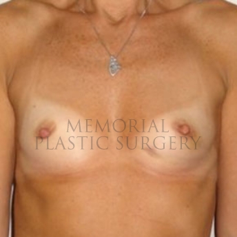 A front view before photo of patient 181 that underwent Nipple Sparing Mastectomy procedures at Memorial Plastic Surgery