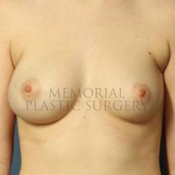 A front view before photo of patient 188 that underwent Nipple Sparing Mastectomy procedures at Memorial Plastic Surgery