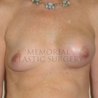 A front view before photo of patient 173 that underwent Nipple Sparing Mastectomy procedures at Memorial Plastic Surgery